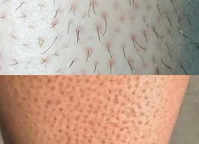 Как убрать раздражение кожи после бритья: чем быстро снять зуд, как избежать появления, полезные советы