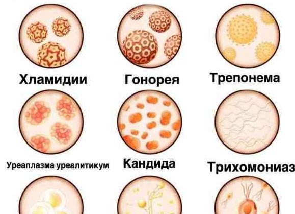 Заболевания, передающиеся половым путем (ЗППП)