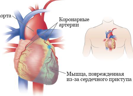 Из-за чего случаются приступы сильного сердцебиения?
