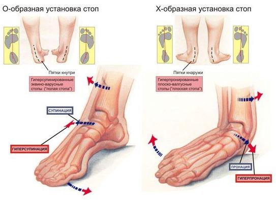 Как плоскостопие влияет на беременность?