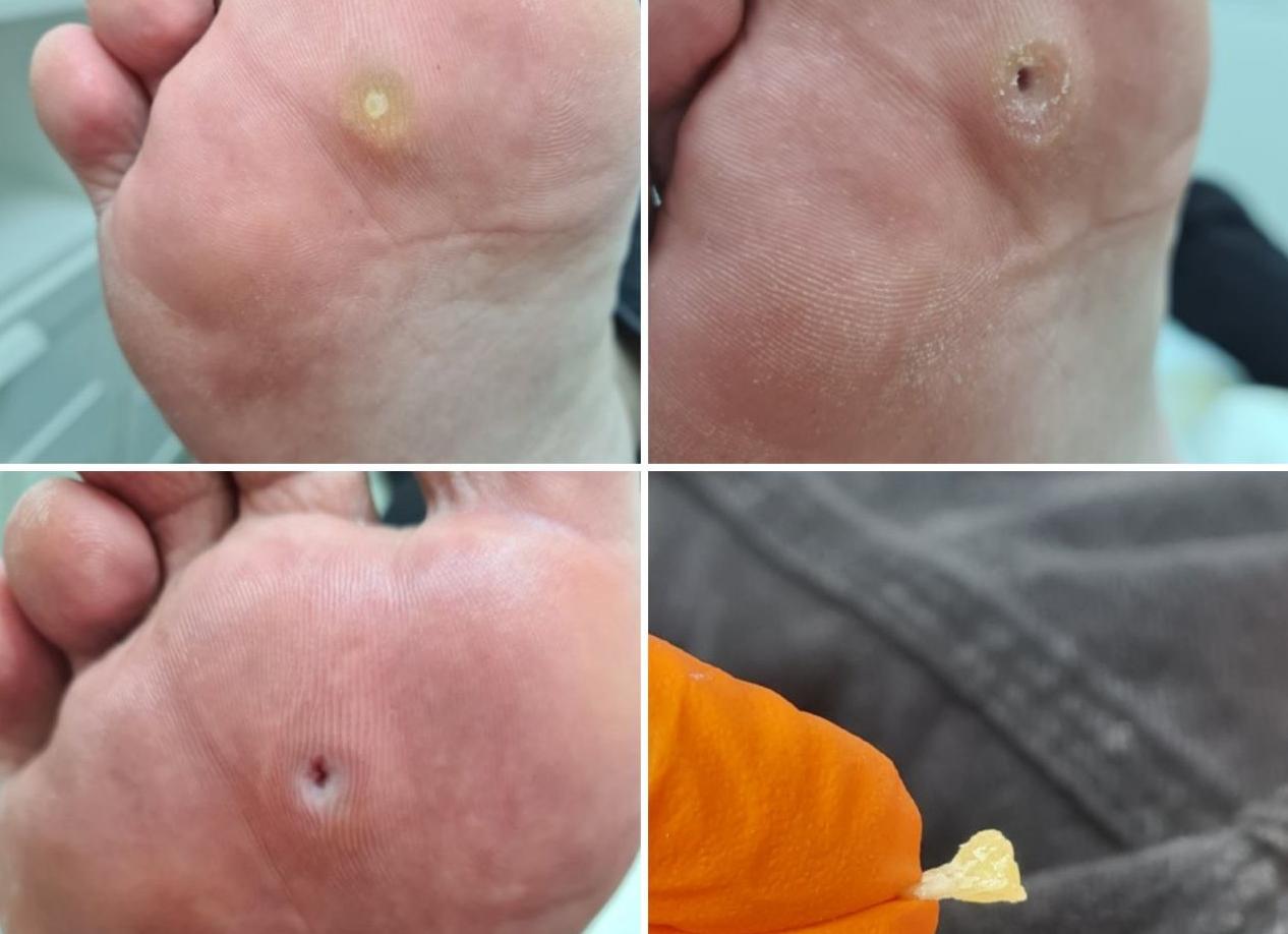 Как избавиться от стержневой мозоли в домашних условиях: эффективные методы и средства