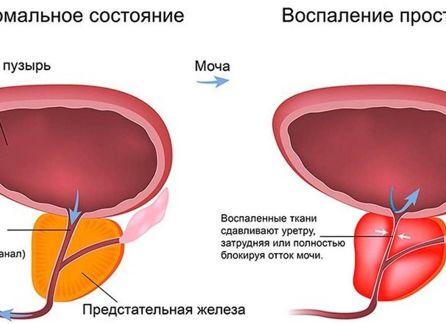 Алкоголь при простатите: нетрадиционное лечение или опасная затея?
