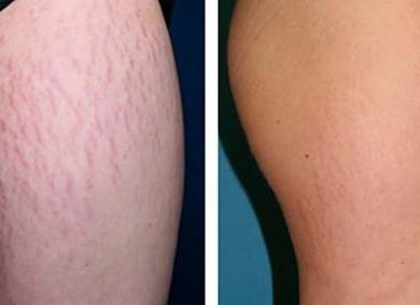 Можно ли избавиться от растяжек?