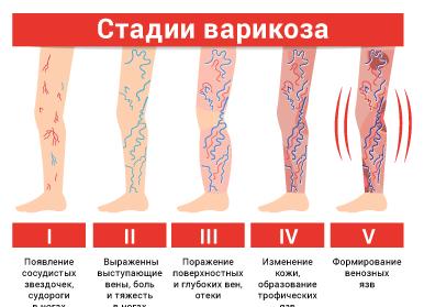 Варикоцеле. Стадии заболевания.